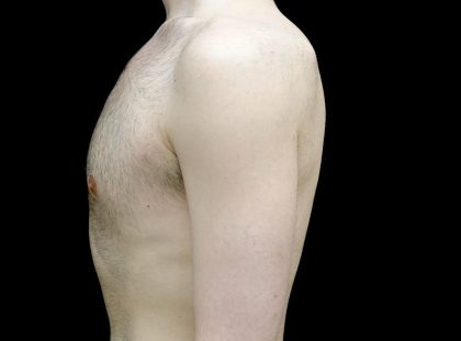 Gynecomastia Before & After Patient #23981