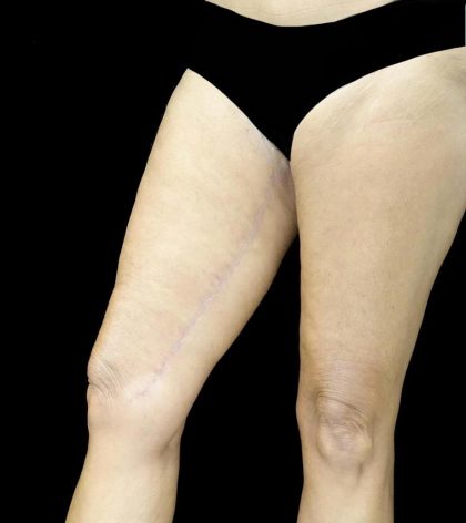Thighplasty Before & After Patient #24071