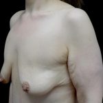 Breast Lift with Implants Before & After Patient #24079