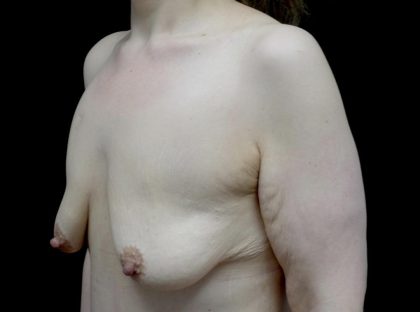 Breast Lift with Implants Before & After Patient #24079