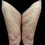 Thighplasty Before & After Patient #24095