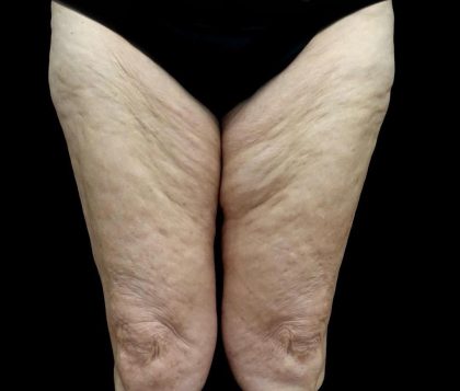 Thighplasty Before & After Patient #24095