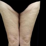 Thighplasty Before & After Patient #24095