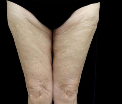 Thighplasty Before & After Patient #24095
