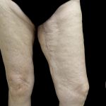 Thighplasty Before & After Patient #24095