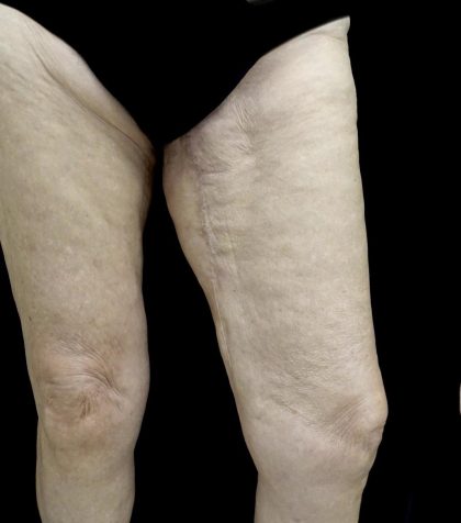 Thighplasty Before & After Patient #24095