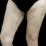 Thighplasty Before & After Patient #24095