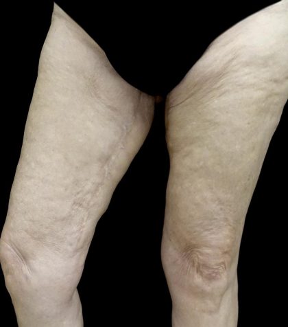 Thighplasty Before & After Patient #24095