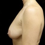 Breast Revision Before & After Patient #24012