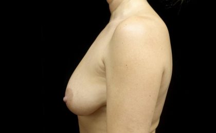 Breast Revision Before & After Patient #24012