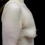 Breast Lift with Implants Before & After Patient #24079