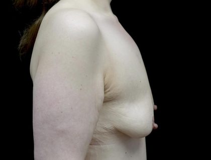 Breast Lift with Implants Before & After Patient #24079