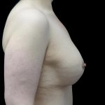 Breast Lift with Implants Before & After Patient #24079