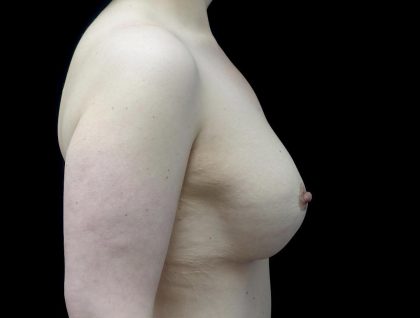 Breast Lift with Implants Before & After Patient #24079