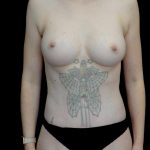 Tummy Tuck Before & After Patient #23984