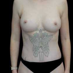 Tummy Tuck Before & After Patient #23984