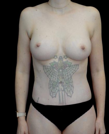 Tummy Tuck Before & After Patient #23984