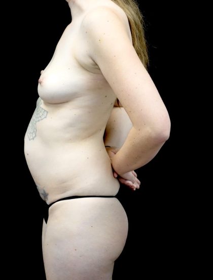 Tummy Tuck Before & After Patient #23984