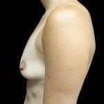 Breast Augmentation (Implants) Before & After Patient #24133