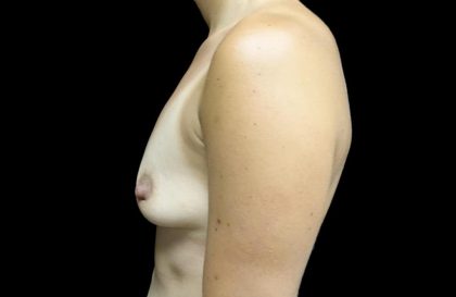 Breast Augmentation (Implants) Before & After Patient #24133