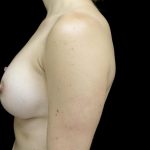 Breast Augmentation (Implants) Before & After Patient #24133