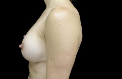 Breast Augmentation (Implants) Before & After Patient #24133