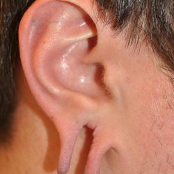 Earlobe Repair Before & After Patient #24184