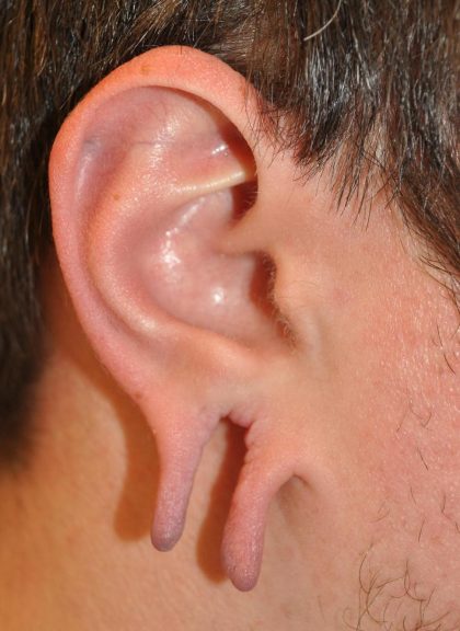 Earlobe Repair Before & After Patient #24184
