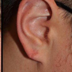 Earlobe Repair Before & After Patient #24184