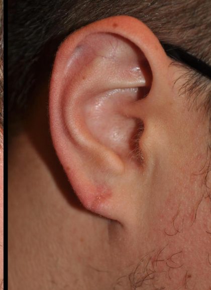 Earlobe Repair Before & After Patient #24184