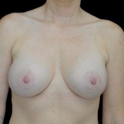 Breast Augmentation (Implants) Before & After Patient #24134