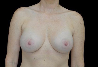 Breast Augmentation (Implants) Before & After Patient #24134