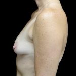 Breast Augmentation (Implants) Before & After Patient #24134