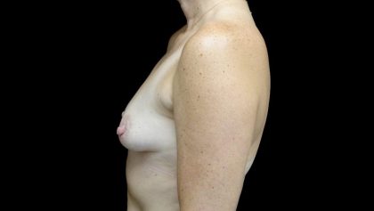 Breast Augmentation (Implants) Before & After Patient #24134