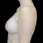 Breast Augmentation (Implants) Before & After Patient #24134