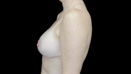 Breast Augmentation (Implants) Before & After Patient #24134