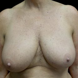 Breast Reduction Before & After Patient #24135