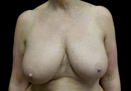 Breast Reduction Before & After Patient #24135