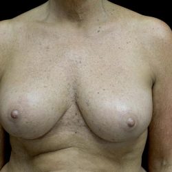 Breast Reduction Before & After Patient #24135