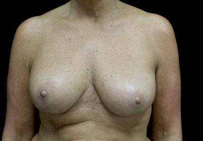 Breast Reduction Before & After Patient #24135