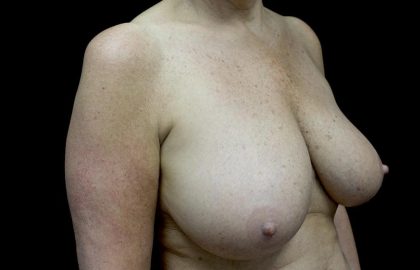 Breast Reduction Before & After Patient #24135