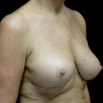 Breast Reduction Before & After Patient #24135