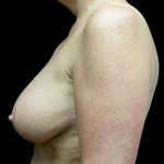 Breast Reduction Before & After Patient #24135