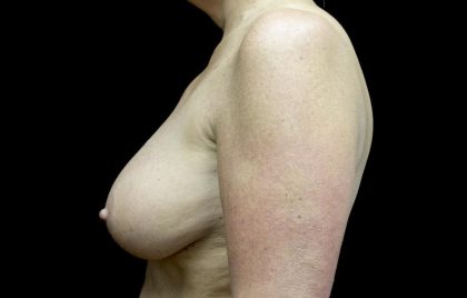 Breast Reduction Before & After Patient #24135
