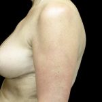 Breast Reduction Before & After Patient #24135