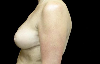 Breast Reduction Before & After Patient #24135