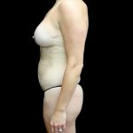 Tummy Tuck Before & After Patient #24136
