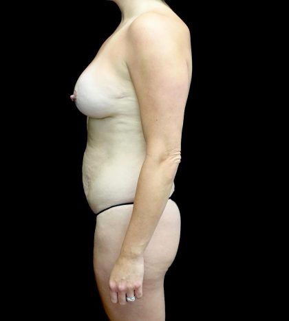 Tummy Tuck Before & After Patient #24136
