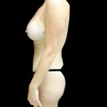 Tummy Tuck Before & After Patient #24136