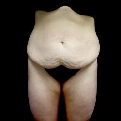 Buttock Augmentation Before & After Patient #24137